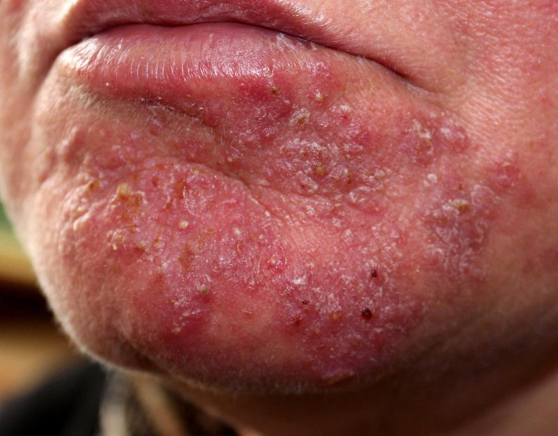 Dieta a trądzik różowaty