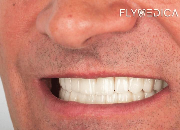 Hollywoodzki uśmiech