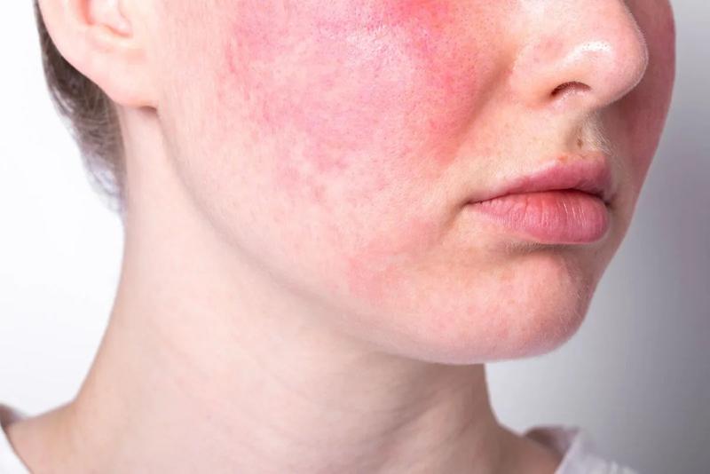 Metody leczenia trądziku