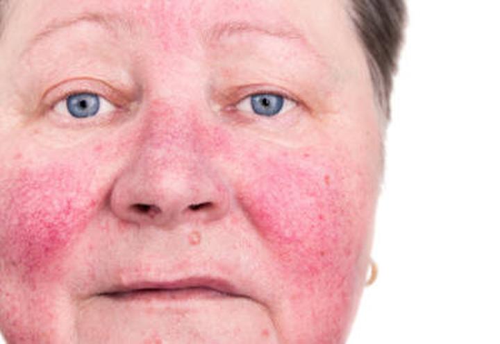 Przyczyny trądziku różowatego