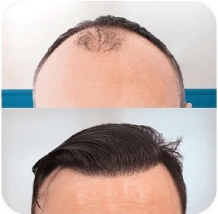 Przebieg zabiegu przeszczepu włosów