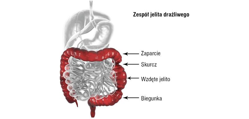 Objawy zespołu jelita drażliwego